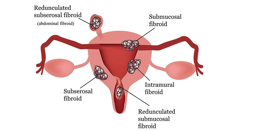 Your uterine fibroids treatment options - Vimarsana News
