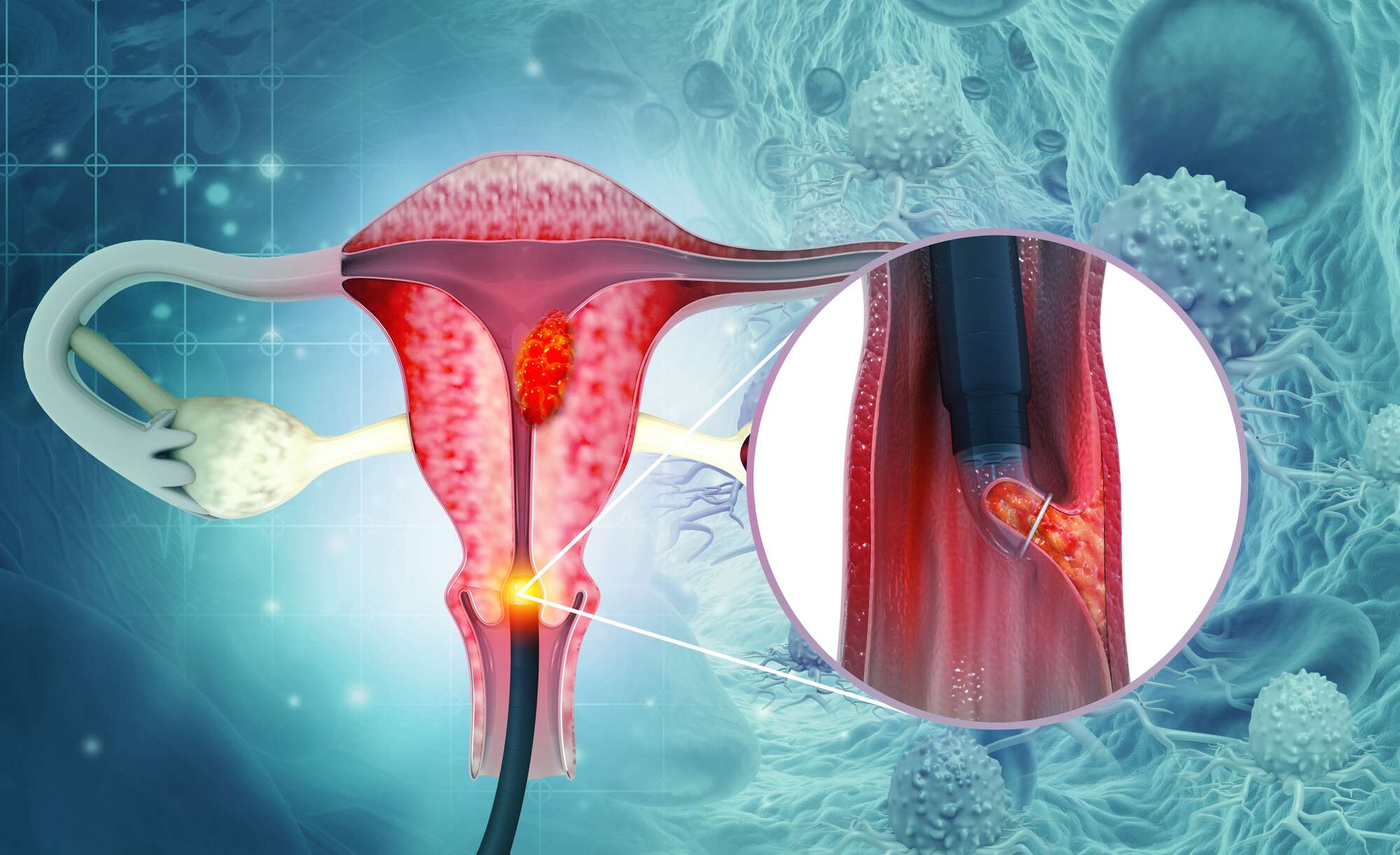 Cervical Cancer: Your prevention and treatment options - Vimarsana News