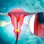 TF260422CervicalCanc(2)