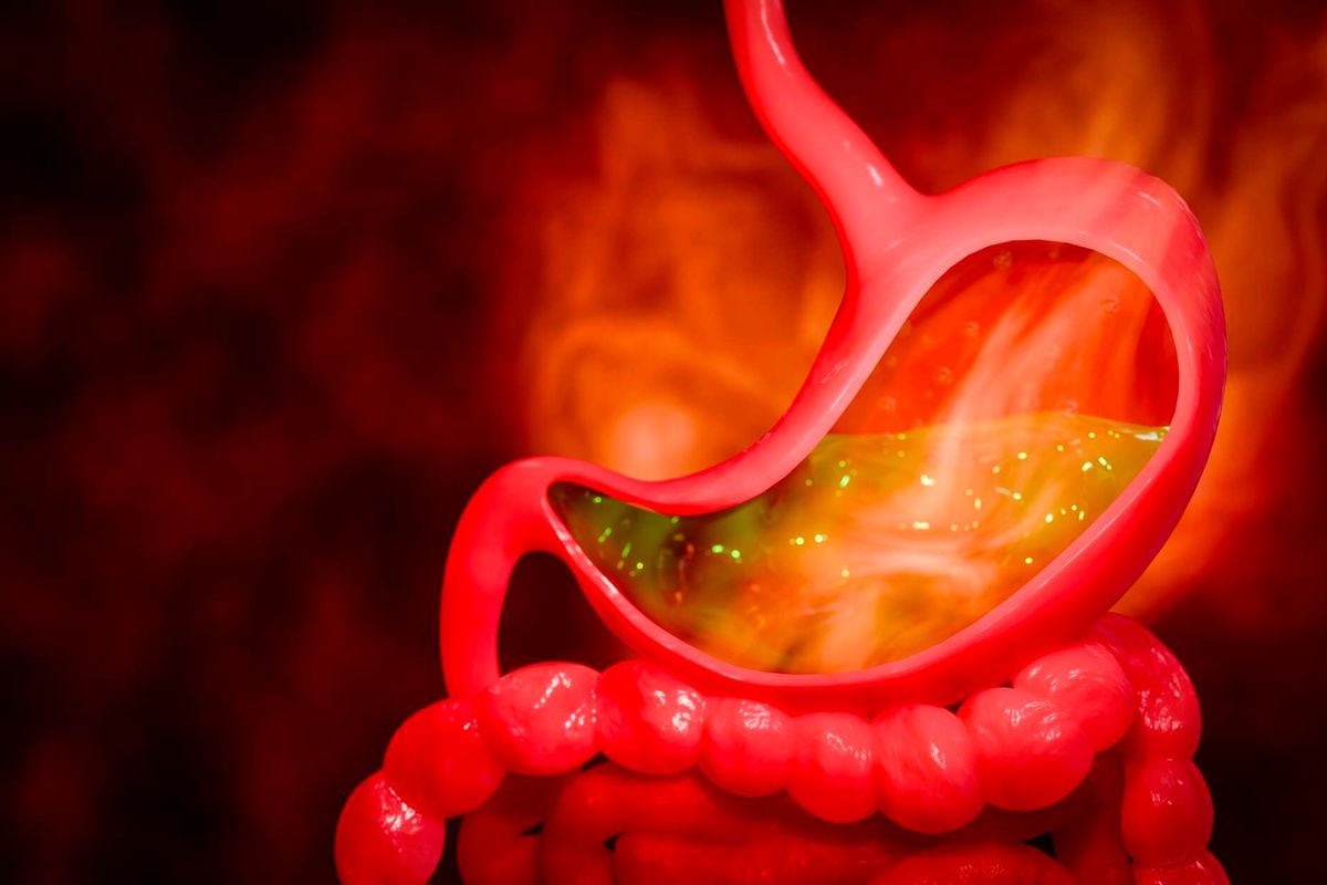 Gambar terkait How to prevent acid reflex and heartburn (dari Bing)